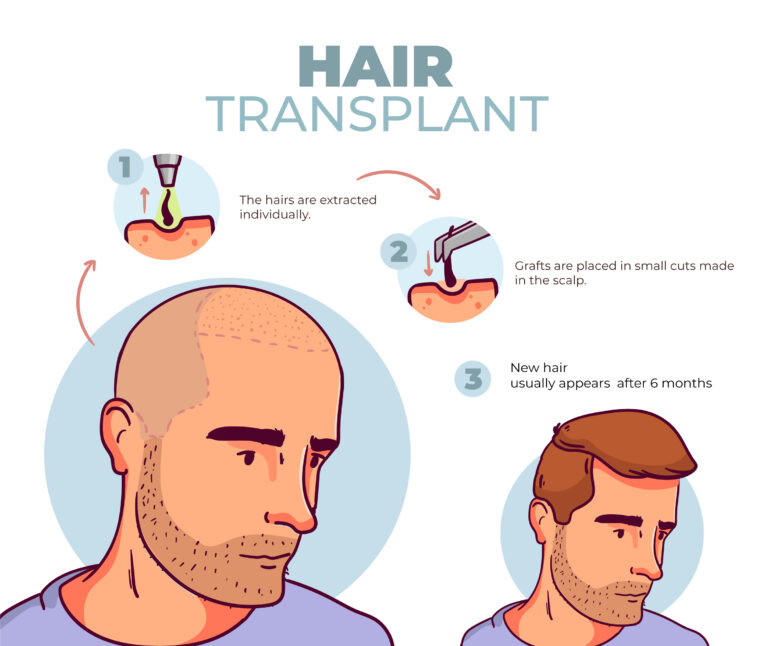 hair-transplant-fue