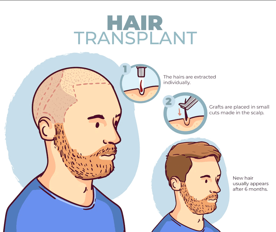 hair-transplant-step